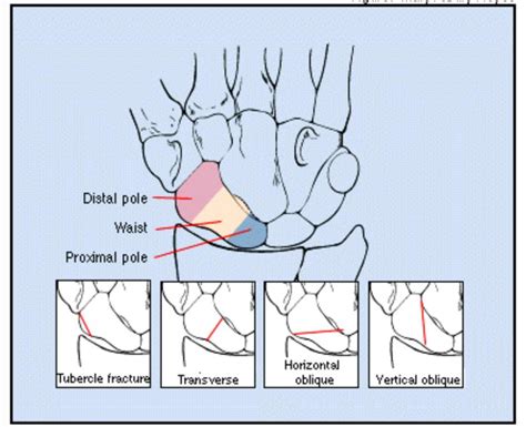 Casting the scaphoid fracture - looking at the research ...