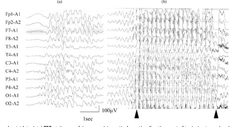 Figure 1 From A Case Of Panayiotopoulos Syndrome Showing An Atypical