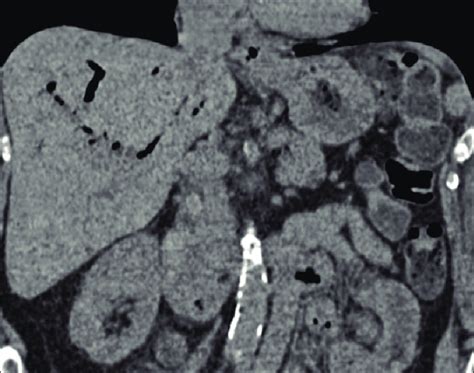 Coronal Ct Scan Shows Pneumobilia White Arrow And Common Bile Duct