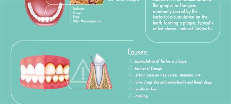 What Is Gingivitis Infographic