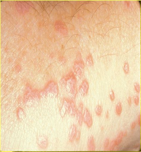 Lichen Planus Symptoms Types And Treatment