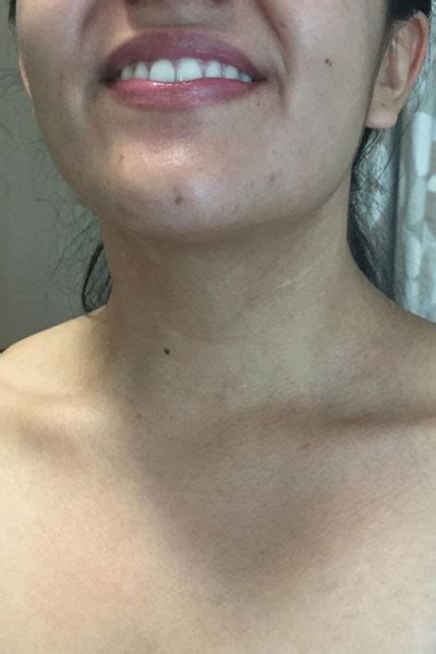 Scar Photos Thyroid Cancer Surgery Thyroidectomy Endocrine Surgery