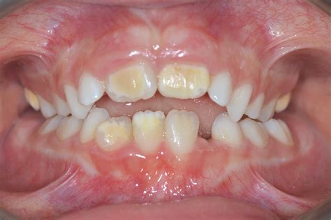 Common Dental Conditions And Prevention