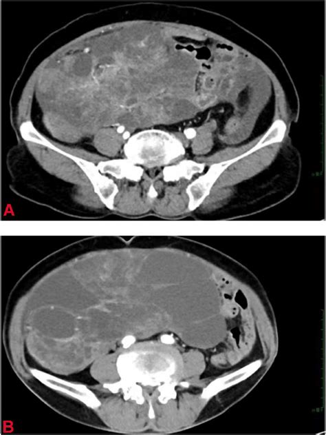 A Ct Shows A Cystic Solid Tumor In The Abdomen B Ct Shows A Larger