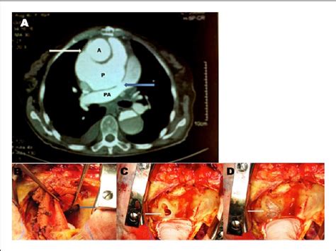 Figure 1 From Treatment Of A Pseudoaneurysm Of The Ascending Aorta In