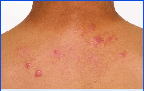 Papular Sarcoidosis As A Cutaneous Manifestation Seen On The Upper Back