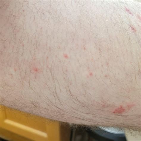 Itchy Spots On Inner Thighs Have Turned Into Horrible Rashes Doctor
