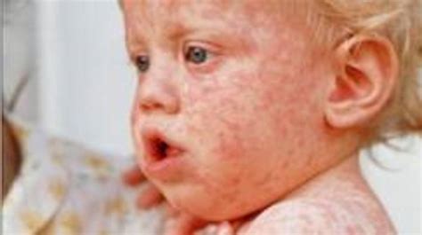 Rubella Or German Measles Symptoms Complications And How To Prevent