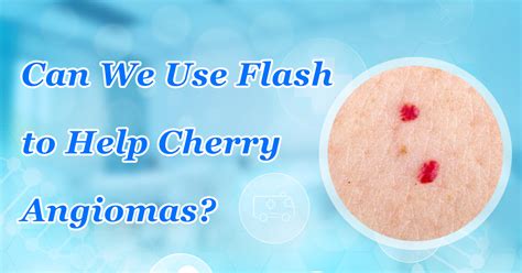 Can We Use Flash To Help Cherry Angiomas Harmless Small And Bright