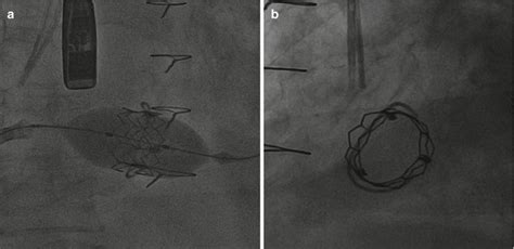 Percutaneous Approaches To Functional Tricuspid Regurgitation