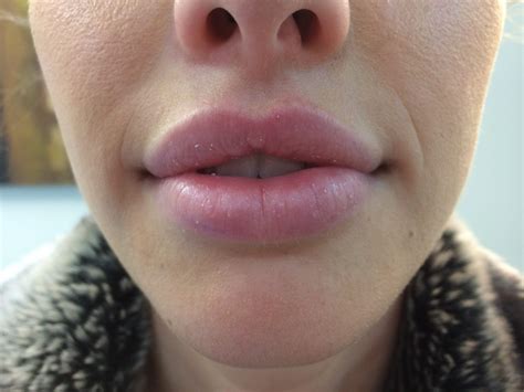 Kissable Lips Made Better With Lip Fillers Creative Truckee