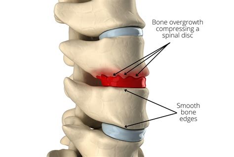 Lumbar Osteophytes Treatment Archives Spinal Backrack