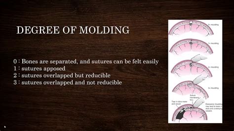 Molding Of Fetal Head By Nadia Naseem Youtube
