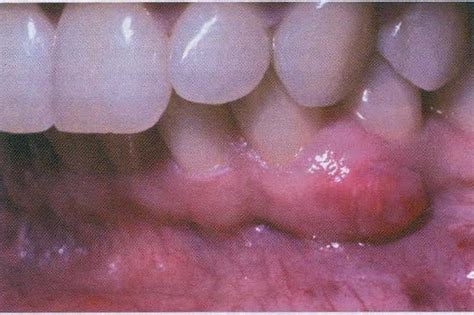 Ibrahims Oral Pathology Blog