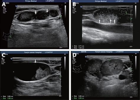 Ultrasound Features Of Extranodal Extension In The Metastatic Cervical