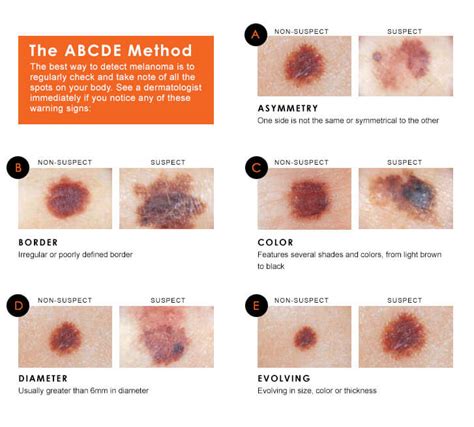 How To Spot The Early Signs Of Melanoma Skin Cancer Babyface