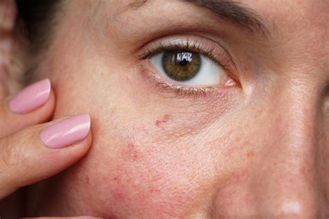 How Do I Treat And Prevent Spider Veins On My Face Zcosmetic Health