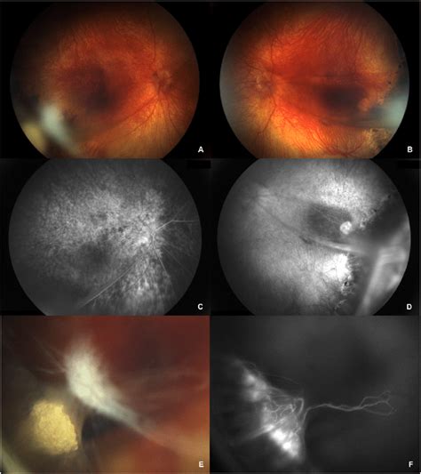 A B Montage Of Fundus Photos Of Both Eyes At 4 Years Of Age C D