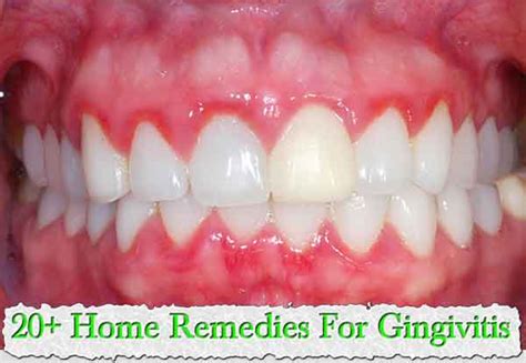 Top 20 Home Remedies For Gingivitis Harcourt Health