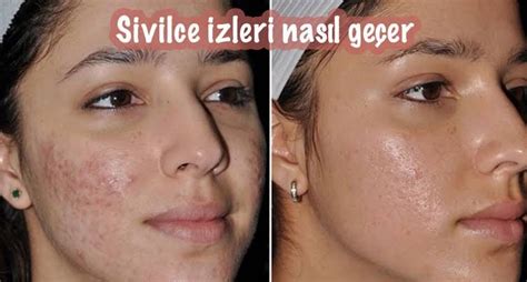 Prevent Acne Remove Acne Best Acne Cream Moderate Acne Acne