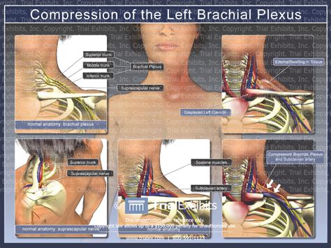 Compression Of The Left Brachial Plexus Trial Exhibits Inc