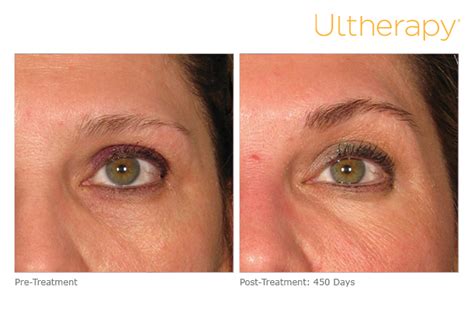 After a brow lift, call your doctor immediately if: Ultherapy NYC Tribeca Skin Center Face Tightening ...