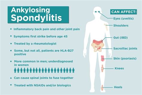 Ankylosing Spondylitis — Chiswick Physio