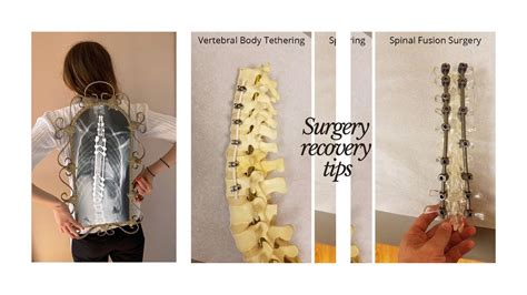 scoliosis surgery recovery tips vbt asc and fusion youtube