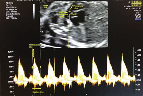 Fetal Main Pulmonary Artery Doppler Flow Trace Download Scientific Diagram