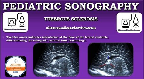 Pediatric Sonography Pediatrics Sonography Tuberous Sclerosis