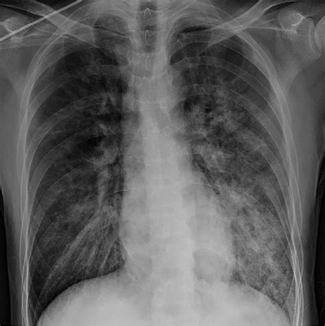 Chest X Ray Of Posteroanterior View Showed Pulmonary Edema Download