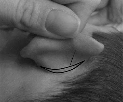 Pediatric Otoplasty Operative Techniques In Otolaryngology Head And