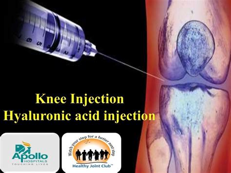 Orthopedic Injections For Knee Pain A Guide For 2023 Martlabpro