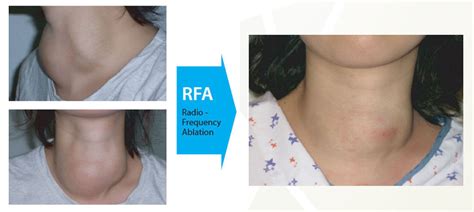 Thyroid Rfa 101 Cosmetic Issues Related To A Big Benign Goiter Nodule