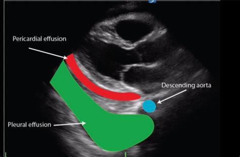 Echocardiography Ch 16 Sonographer S Perspective Flashcards Quizlet