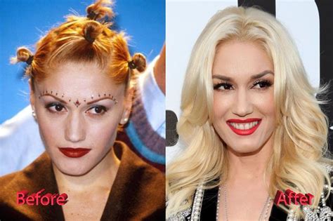 Gwen Stefani Before And After Surgery Gwen Stefani Celebrity Plastic