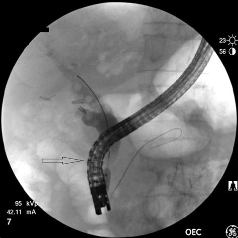 Ercp Showing Bile Duct And Pancreatic Duct Access Via The Download