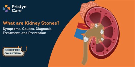 What Are Kidney Stones Causes Symptoms Diagnosis Treatment And
