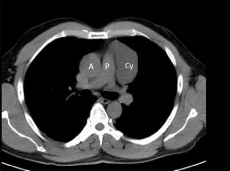 Contrast Enhanced Ct Of The Chest Transverse View Showing The Cyst