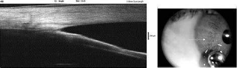Figure 1 From Cystoid Macular Edema After Cataract Surgery In A Patient