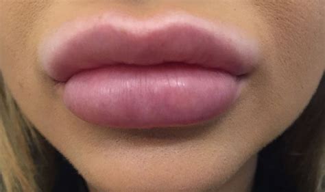 Save Face In The Express Revealed Lip Filler Frenzy Leaving Teenage