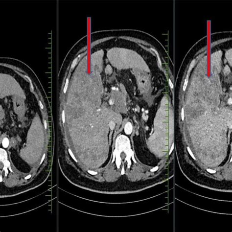 Triple Phase Liver Imaging Axial Ct Shows Ill Defined Heterogeneously