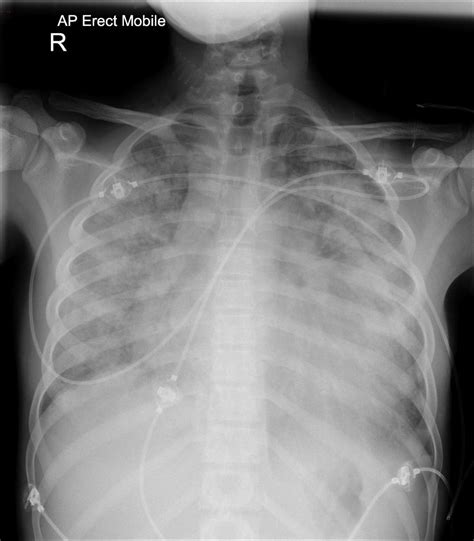 Rheumatic Fever Chest X Ray Wikidoc