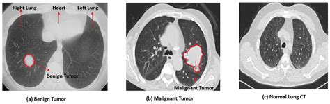 Benign Lung Tumor