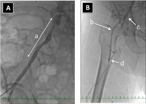 Intraoperative Angiogram Shows A Successful Iliac Stenting A And Good