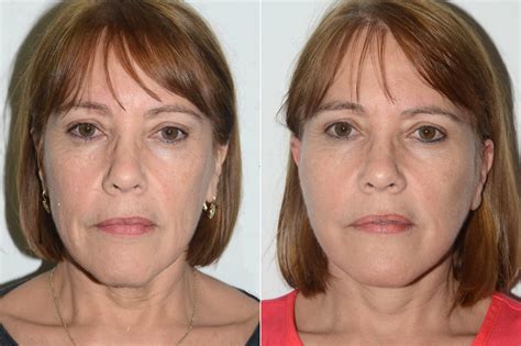Lifting Facial Facelift Fotos Coral Gables Fl Paciente 16508