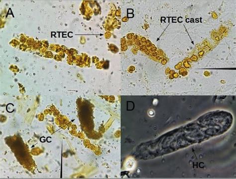 When is bacterial contamination expected? Fresh and unstained urine sediment. A: Renal tubular ...