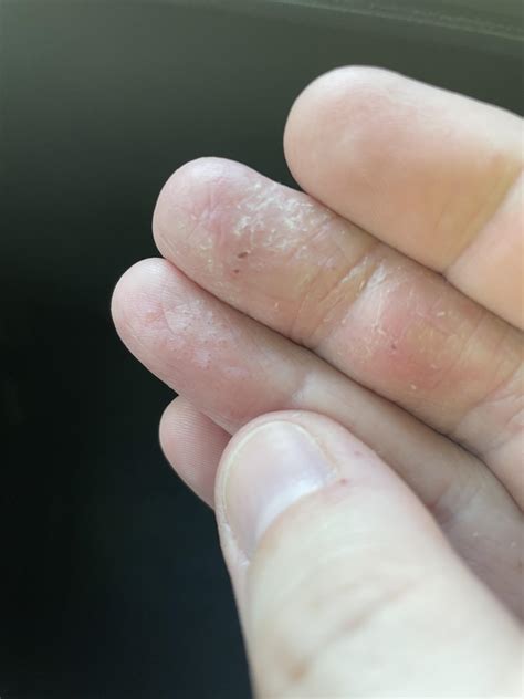 I Get This On Two Fingers Only These Bubbles That Form Then They