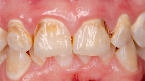Meth Mouth Signs Symptoms Causes Treatment