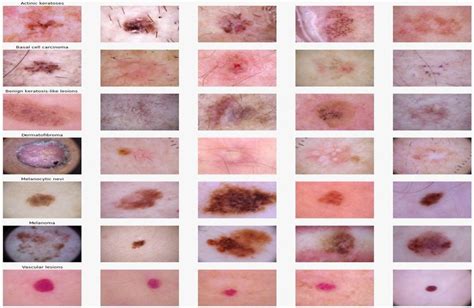 Early Stages Of Melanoma Skin Cancer